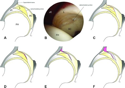 grades of hip labral tears